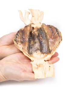 Abdominaal Aorta Aneurysma, 3D Print