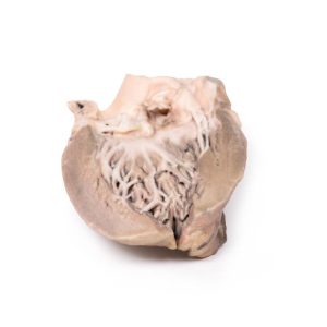 Acute Bacteriële Endocarditis, 3D Print