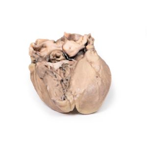 Acute Bacteriële Endocarditis, 3D Print