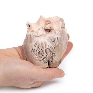 Acute Bacteriële Endocarditis, 3D Print