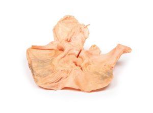 Adenomacarcinoom in de Maag, 3D Print