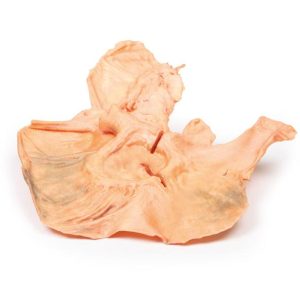 Adenomacarcinoom in de Maag, 3D Print