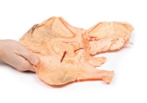 Adenomacarcinoom in de Maag, 3D Print