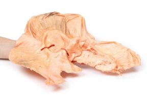 Adenomacarcinoom in de Maag, 3D Print
