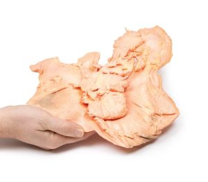Adenomacarcinoom in de Maag, 3D Print