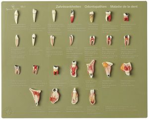 Anatomisch model tandheelkundige aandoeningen