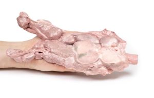 Aorta & Para-aortale Lymfeklieren, 3D Print