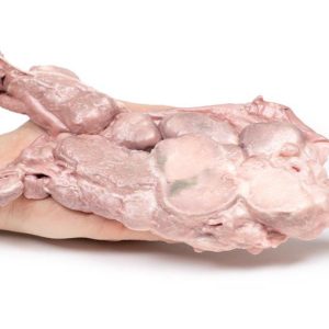 Aorta & Para-aortale Lymfeklieren, 3D Print