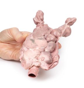 Aorta & Para-aortale Lymfeklieren, 3D Print