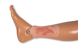 Arteriële Beenzweer Wond, Epithelisatiefase