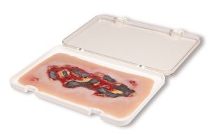 Arteriële Beenzweer Wond, Exsudatiefase
