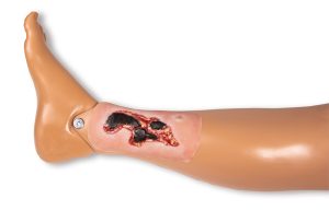 Arteriële Beenzweer Wond, Exsudatiefase
