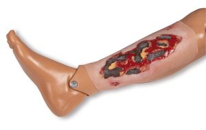 Arteriële Beenzweer Wond, Exsudatiefase