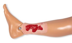 Arteriële Beenzweer Wond, Granulatiefase