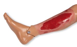 Arteriële Beenzweer Wond, Granulatiefase