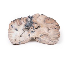 Arterioveneuze Malformatie in de Hersenen, 3D Print