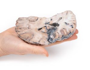 Arterioveneuze Malformatie in de Hersenen, 3D Print