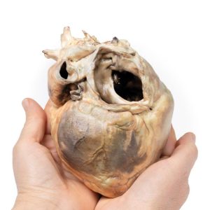 Atriumseptumdefect, 3D Print