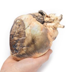 Atriumseptumdefect, 3D Print