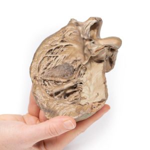 Bicuspide Aortaklep, 3D Print