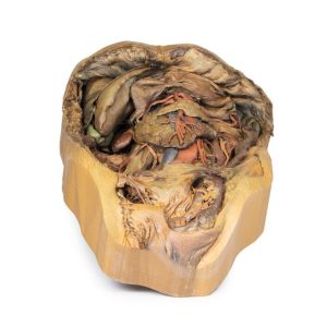 Buik met Liesbreuk, 3D Print