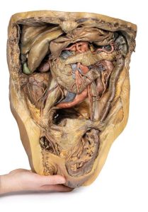 Buik met Liesbreuk, 3D Print