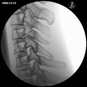 Beeldgeleide Cervicale Wervelkolom Injectie Simulator