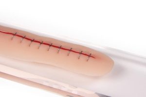 Chirurgische Wond Model