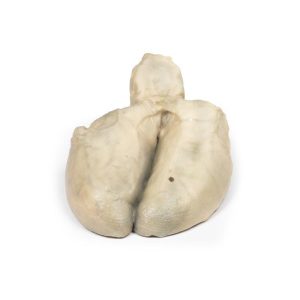 Cholecystitis en Cholelithiasis, 3D Print
