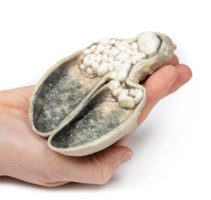 Cholecystitis en Cholelithiasis, 3D Print