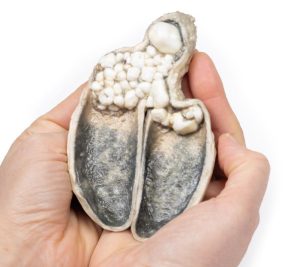 Cholecystitis en Cholelithiasis, 3D Print