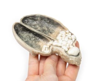 Cholecystitis en Cholelithiasis, 3D Print