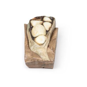 Cholelithiasis (Galstenen), 3D Print