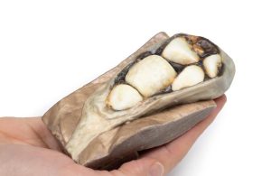 Cholelithiasis (Galstenen), 3D Print