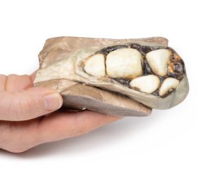 Cholelithiasis (Galstenen), 3D Print