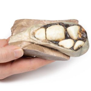 Cholelithiasis (Galstenen), 3D Print