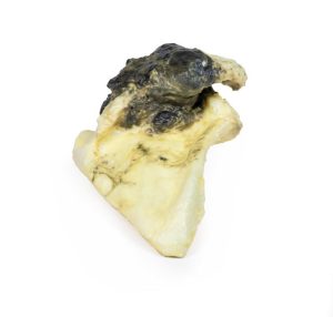 Chondrosarcoom in Schouderblad, 3D Print