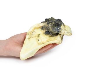 Chondrosarcoom in Schouderblad, 3D Print