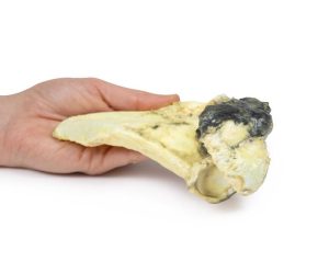 Chondrosarcoom in Schouderblad, 3D Print