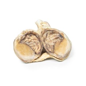 Chronische Hydrocele, 3D Print