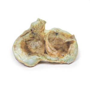 Chronische Hydrocele, 3D Print