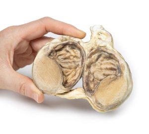 Chronische Hydrocele, 3D Print