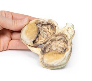 Chronische Hydrocele, 3D Print