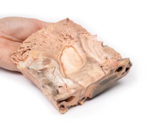 Chronische Maagzweer, 3D Print