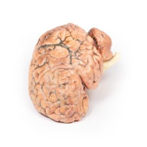 Craniofaryngioom, 3D Print