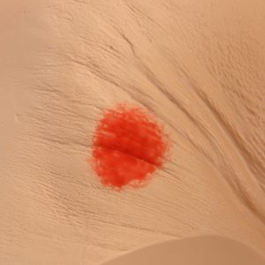 Decubitus (Ulcus) model