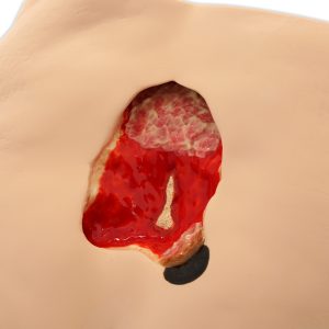 Decubitus (Ulcus) model