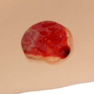 Decubitus (Ulcus) model