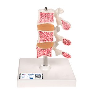 Deluxe Osteoporose model
