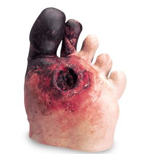Diabetisch Voetmodel